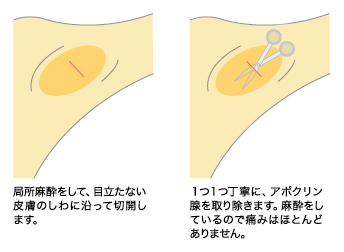 保険 適用 手術 わきが